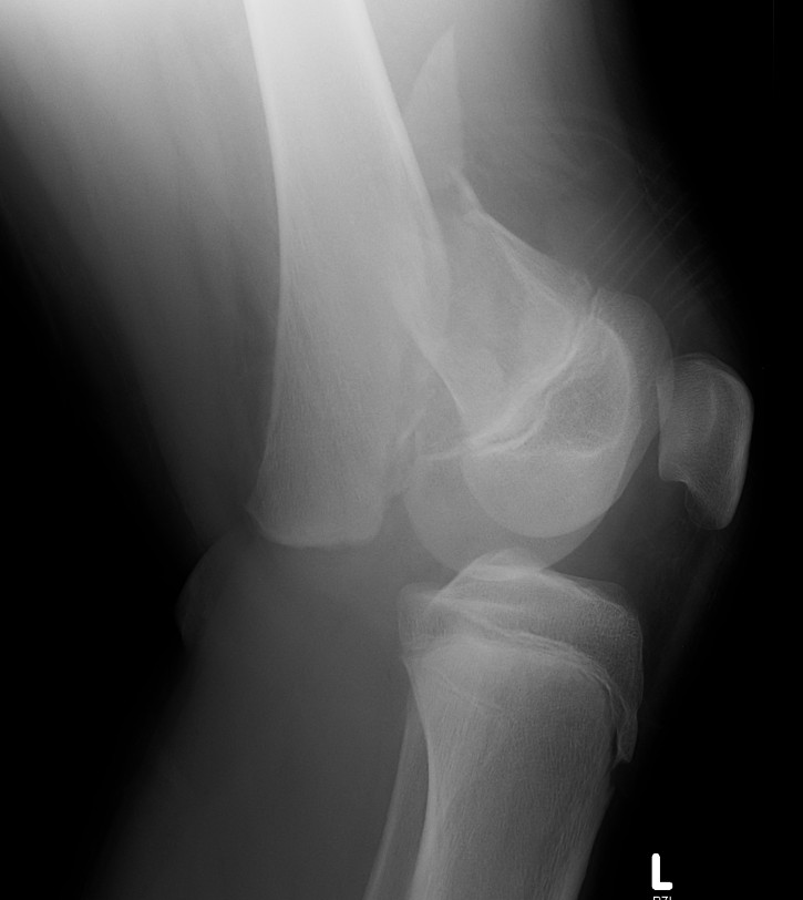 SH2 Distal Femoral Fracture Lateral